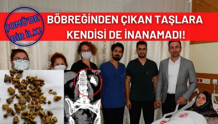 Böbreğinden çıkan taşlara kendisi de inanamadı! (VİDEO)