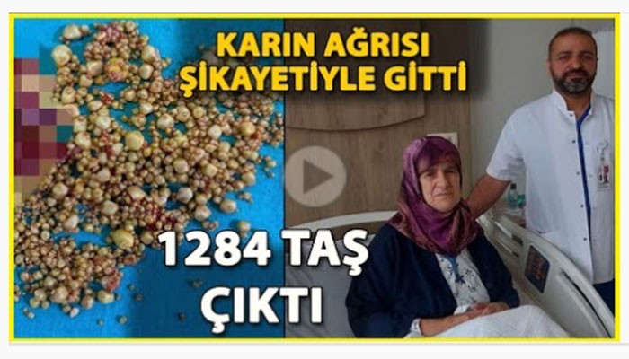 Safra kesesinden 1284 taş çıktı (VİDEO)