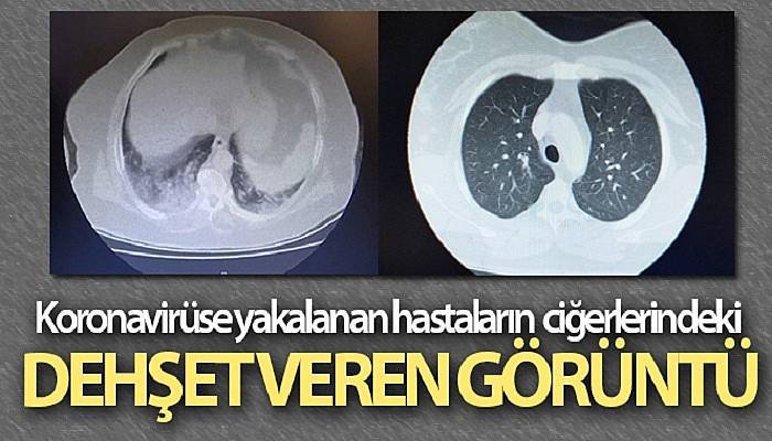 Koronavirüse yakalanan hastaların ciğerlerindeki dehşet veren görüntü