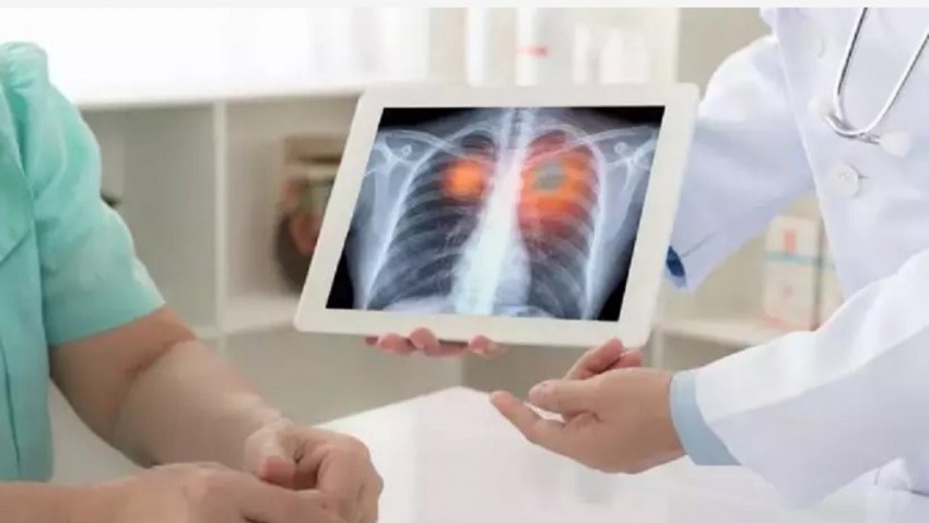 Akciğer Kanserine Karşı 3B Kuralı