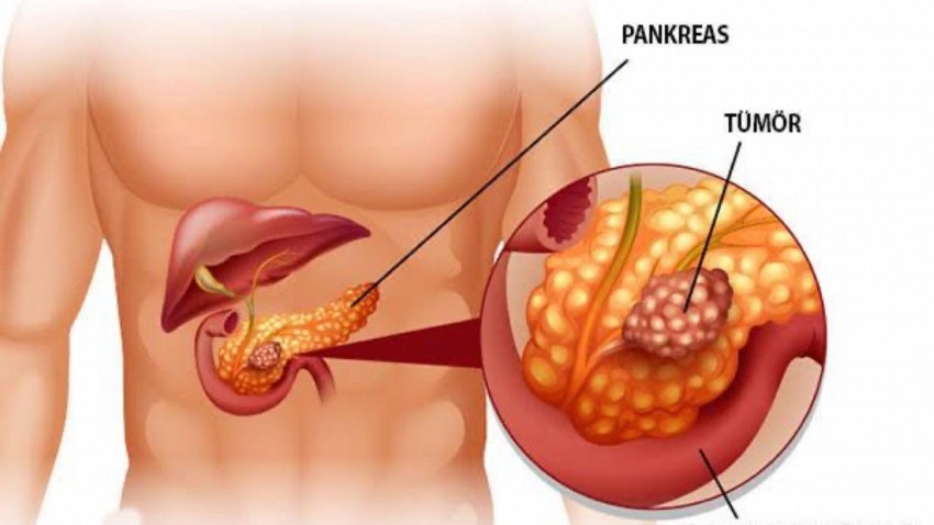 Pankreas Kanserinin Tedavisinde Cerrahinin ve Girişimsel Radyolojinin Rolü