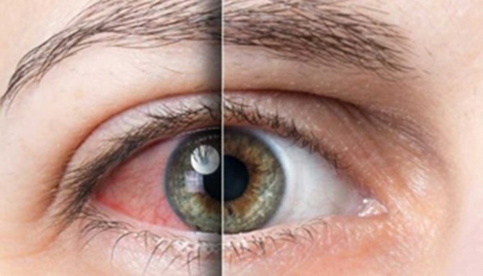 En Tehlikeli Göz Hastalıkları Çeşitleri Nelerdir?