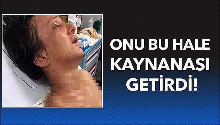 Kaynananın gelinini kızgın yağ ile yaktığı iddiası