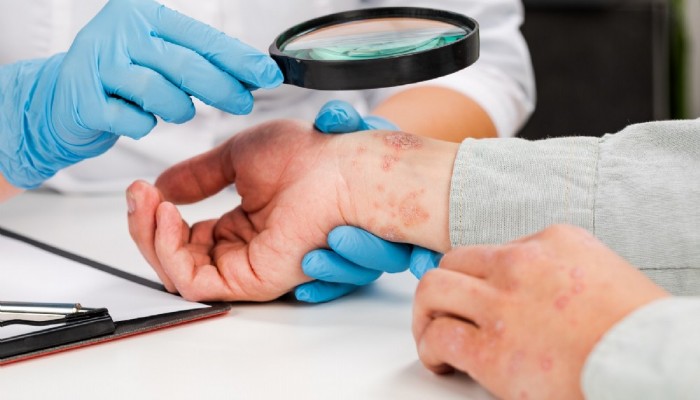 Kontakt Dermatit Nedir? Belirtileri ve Tedavi Yöntemleri Nelerdir?