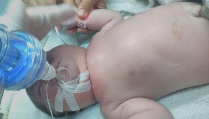 Doğum sırasında bebeğin köprücük kemiğinin kırıldığı iddiası (VİDEO)