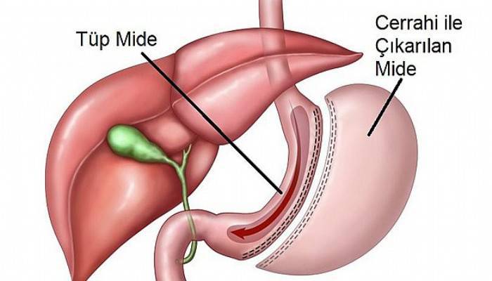  Tüp Mide Ameliyatı 'Mide Küçültme' Kimlere Uygulanır?
