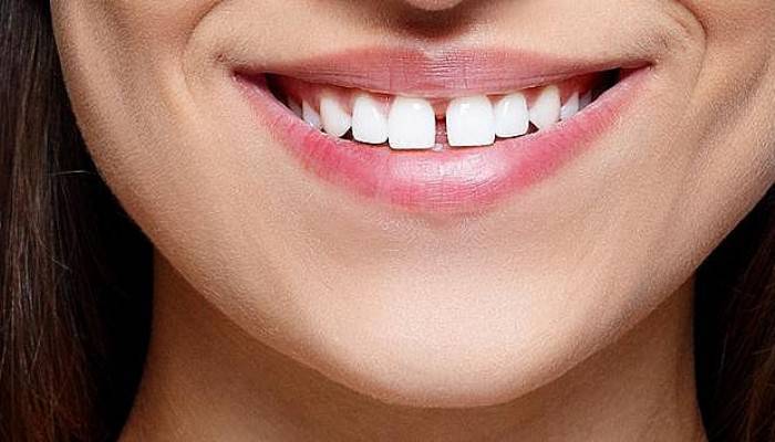 Aralıklı dişler sadece estetik bir sorun mu?