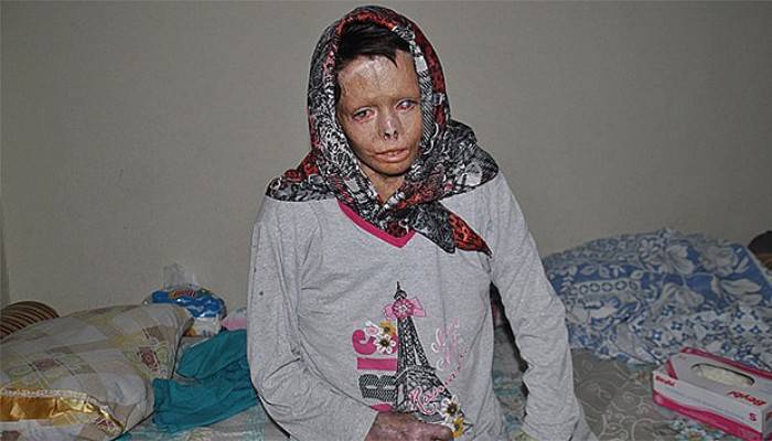 Esad'ın yaktığı Suriyeli Nuha Türkiye'de şifa buluyor