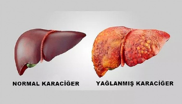 Karaciğer Yağlanmasına Dikkat