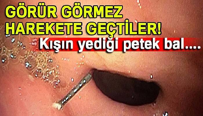 Petek bal yedi, midesinden 10 santim tel çıktı