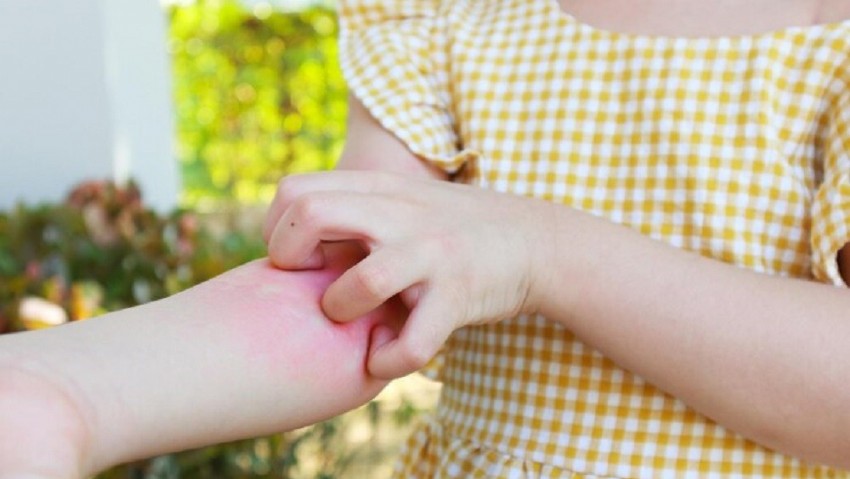 Sivrisinek alerjisi nedir?