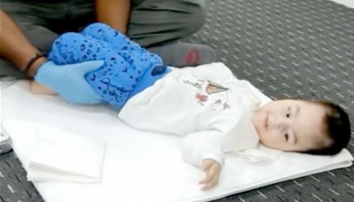 Ahmet Alp Bebeğin Tedavisi Devam Ediyor