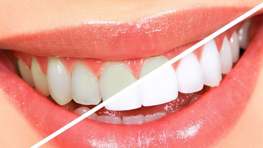  Diş Beyazlatma Yöntemleri