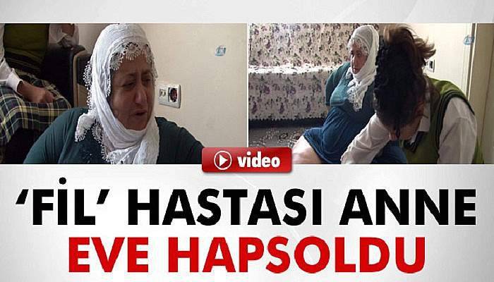 ‘Fil’ hastası anne, eve hapsoldu