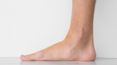 Düztaban (Pes Planus) Nedir?
